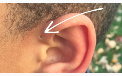 為何有些人天生耳朵上有個小洞？專家說明原因讓人驚呆了...