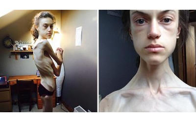 22歲厭食症患者「瘦到已經隨時會死掉」，然而開了IG帳號後她奇蹟地慢慢獲救